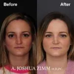 Rhinoplasty - before and after