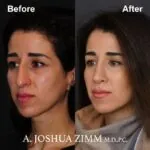 Rhinoplasty - before and after