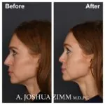 Rhinoplasty - before and after