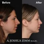 Rhinoplasty - before and after