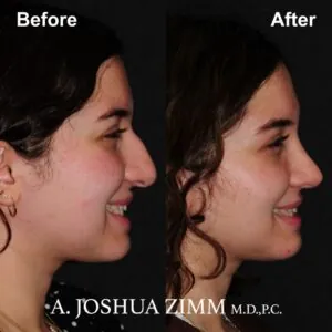 4-rhinoplasty-before-and-after Rhinoplasty - before and after