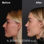 Rhinoplasty - before and after