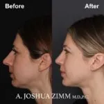 Rhinoplasty - before and after