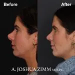 Rhinoplasty - before and after