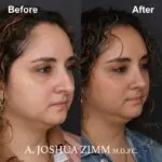 Rhinoplasty - before and after
