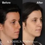 Rhinoplasty - before and after