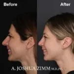 Rhinoplasty - before and after