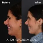 Rhinoplasty - before and after