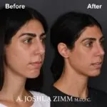 Rhinoplasty - before and after
