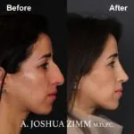 Rhinoplasty - before and after