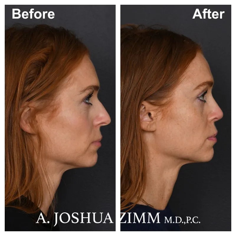 Rhinoplasty - before and after