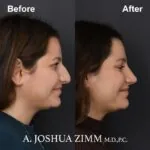 Rhinoplasty - before and after