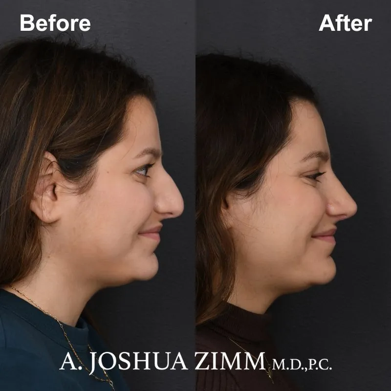 Rhinoplasty - before and after