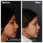 Rhinoplasty - before and after