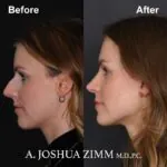 Rhinoplasty - before and after