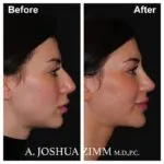 Chin implant - before and after