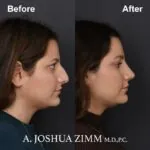 Rhinoplasty - before and after