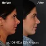 Rhinoplasty - before and after