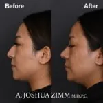 Rhinoplasty - before and after