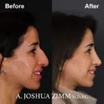 Rhinoplasty - before and after