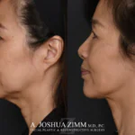 Facelift_Before_after