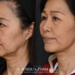 Facelift_Before_after