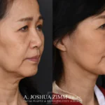 Facelift_Before_after