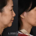 Facelift_Before_after