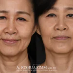 Facelift_Before_after