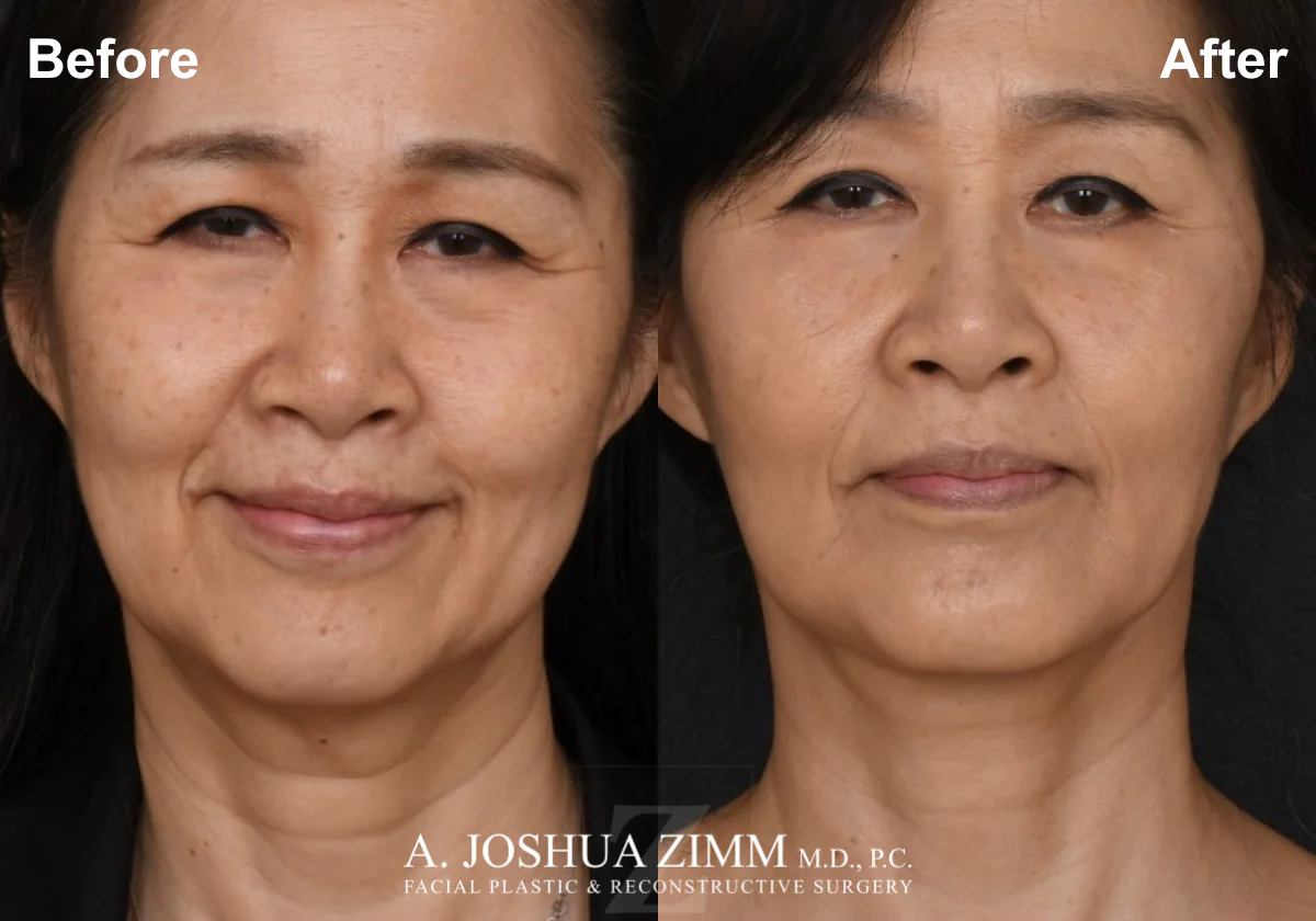 Facelift_Before_after