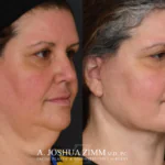 Facelift before after