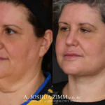 Facelift before after