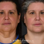 Facelift before after