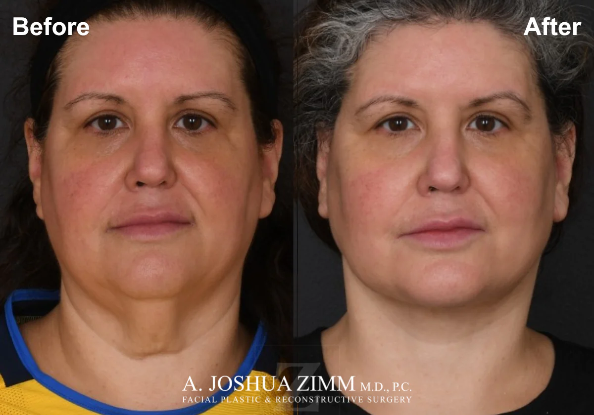 Facelift before after