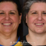 Facelift before after